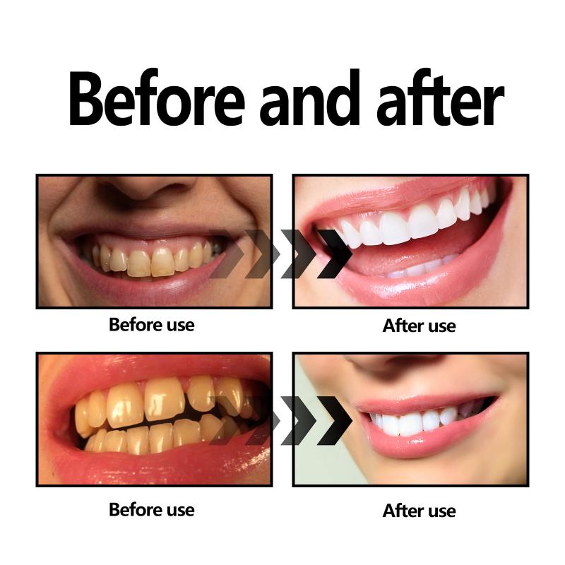 Teeth Whitening Powder Charcoa - Whitening Teeth Using Baking Soda recension och pris