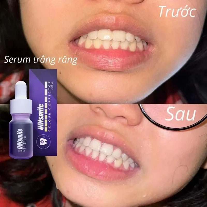 Unismile Teeth Whitening Essen - Teeth Whitening Effective recension och pris