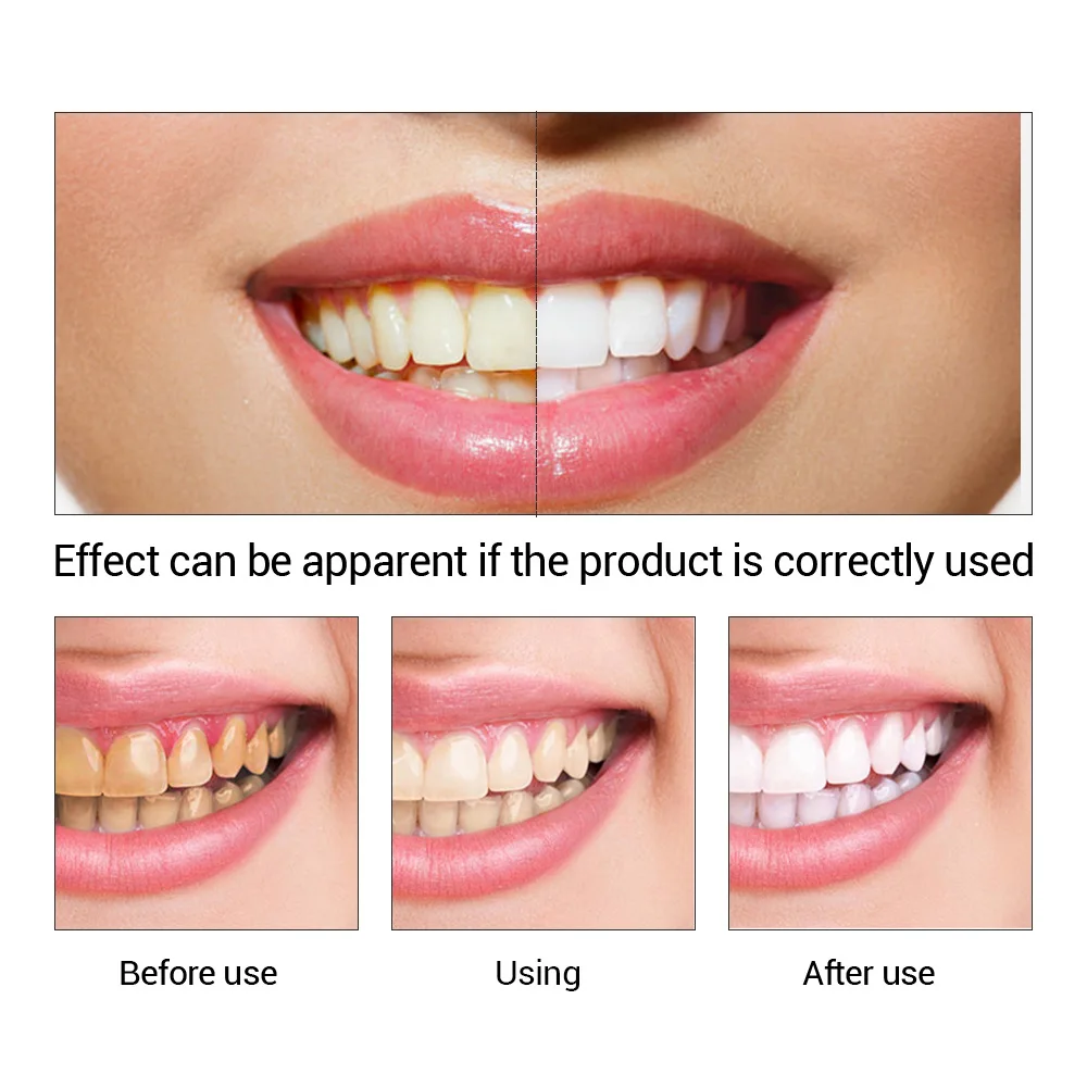 FTEENPLY Teeth Whitening Essen - Teeth Whitening Vape recension och pris