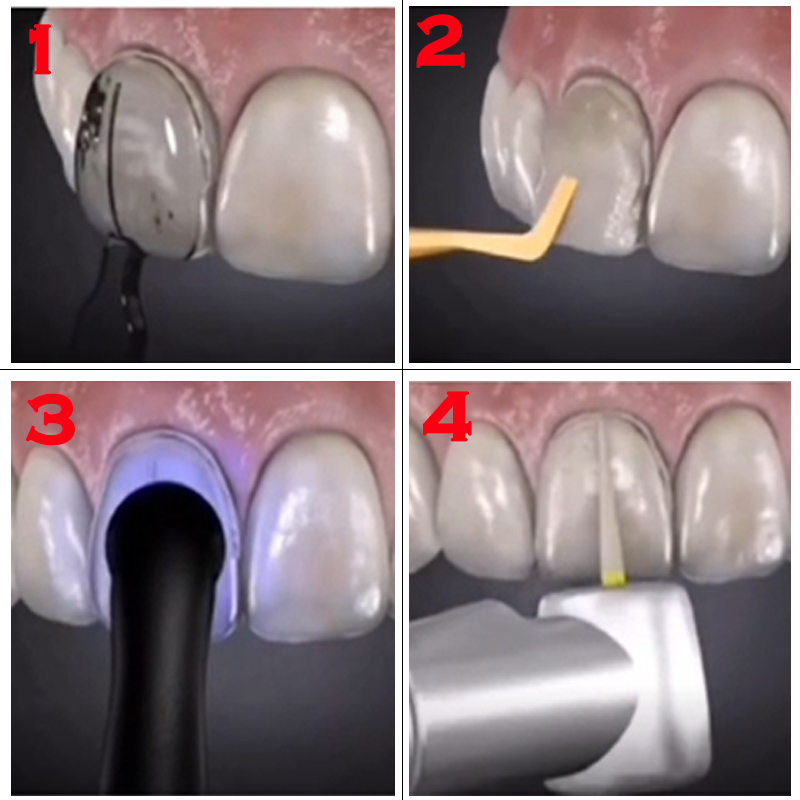 Dental Mold for Composite Resi - Teeth Whitening Veneers recension och pris