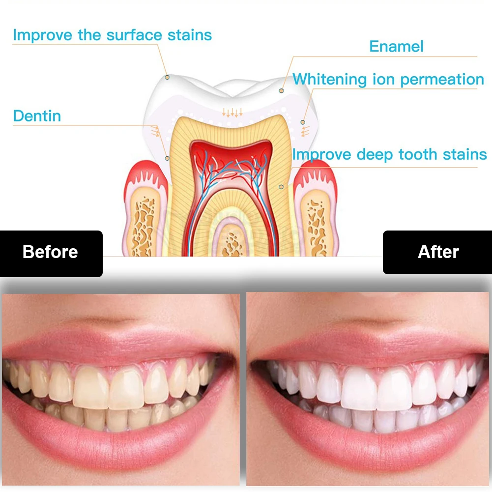 Dental Teeth Whitening Kit Min - Teeth Whitening Vape recension och pris